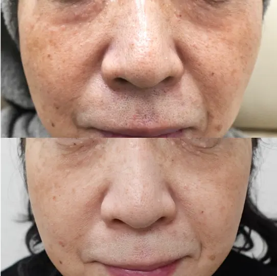 顔広範囲の肝斑含む色素沈着の症例2